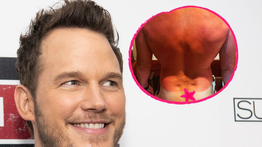 Das muss wehtun! Chris Pratt präsentiert Mega-Sonnenbrand