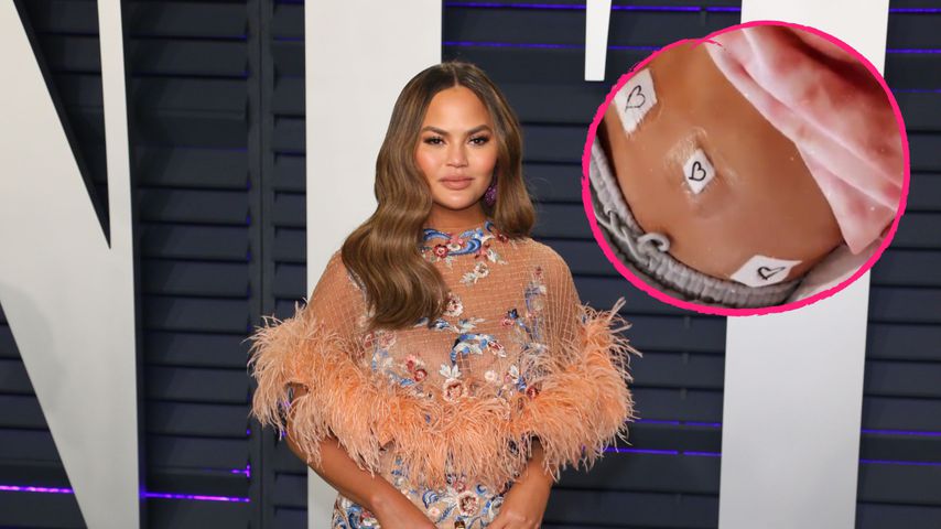 Nach Fehlgeburt: Chrissy Teigen hat eine Endometriose-OP