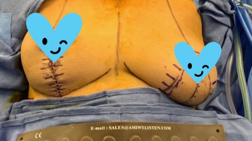 Chrissy Teigen kurz nach ihrer Brust-OP