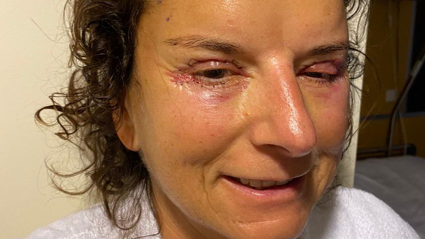 Claudia Obert nach ihrer Lidstraffung