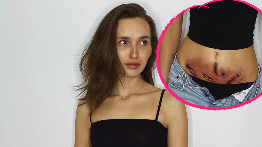 Mutig: Anna Wilken zeigt die Auswirkungen einer Endometriose