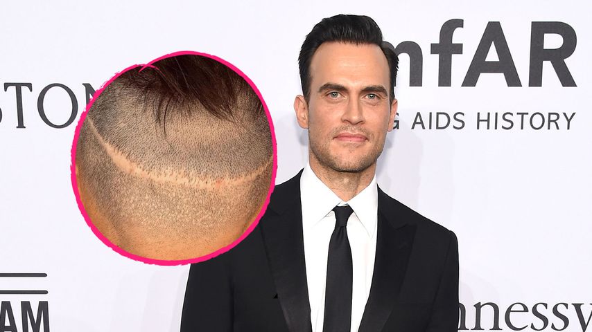"Glee"-Star lässt sich seit 16 Jahren Haare transplantieren