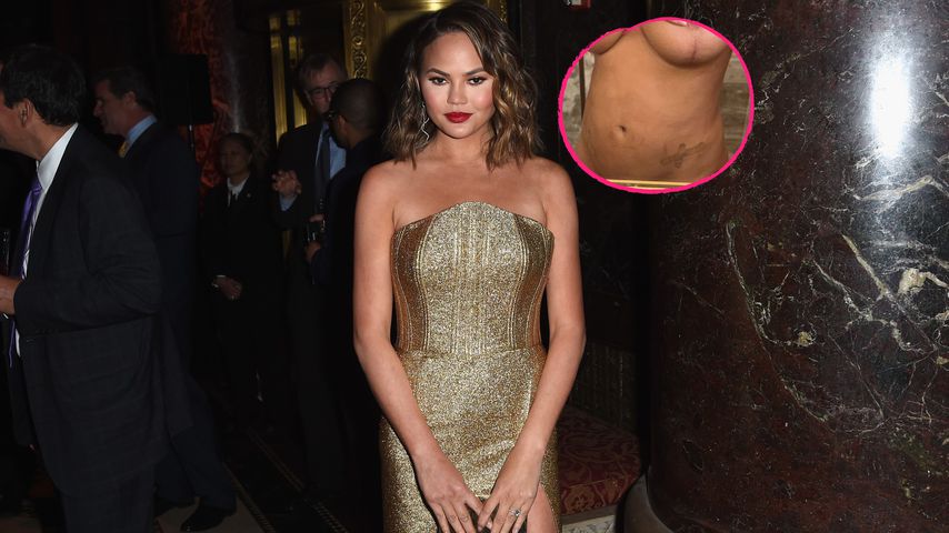 Kurz nach Endometriose-OP: Chrissy Teigen zeigt sich nackt