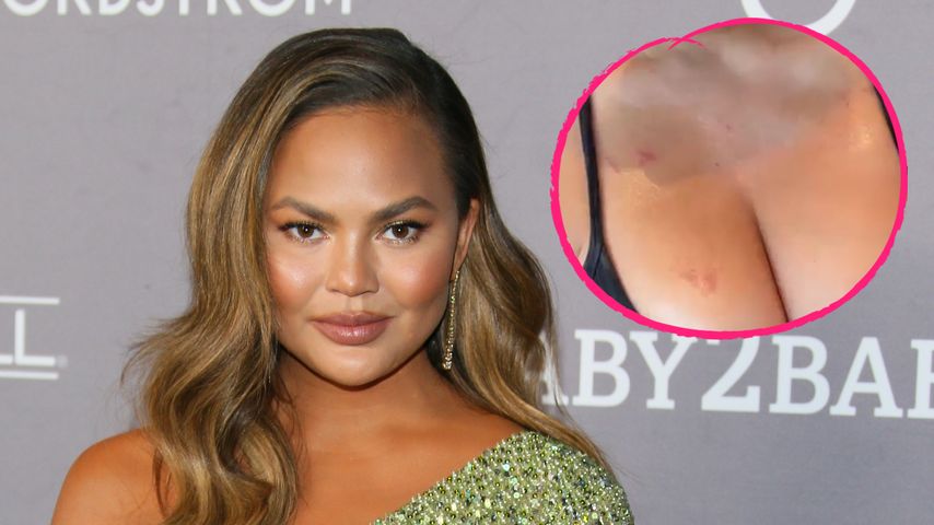 Fruchtbarkeitsbehandlung: Chrissy Teigen zeigt ihre Wunden