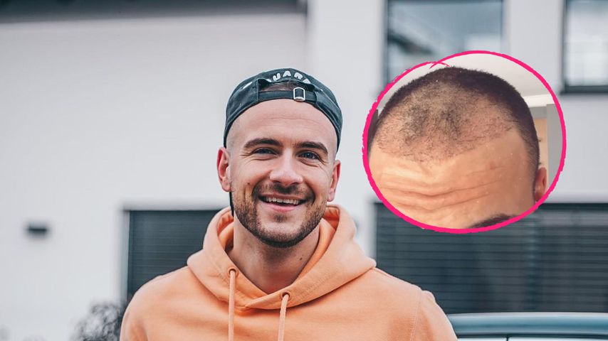Nach Haartransplantation: Daniel Gielniak gibt ein Update