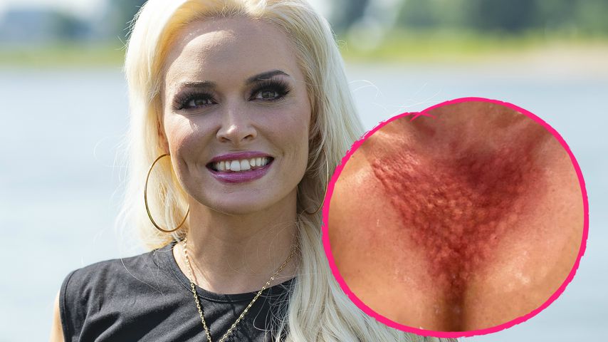 Dicke Pusteln? Daniela Katzenberger schockt mit Dekolleté!