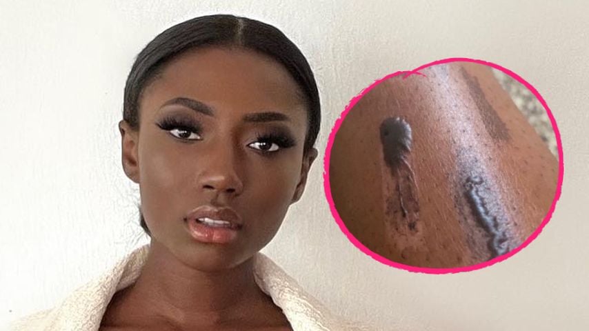 Fiese Verbrennungen: GNTM-Jasmin ärgert sich über Laser-Fail