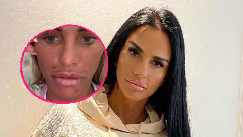 Fieser Botox-Fail! Katie Price konnte nicht mehr lächeln