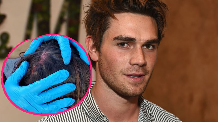 Nach Augenverletzung: Pechvogel KJ Apa hat blutige Kopfwunde