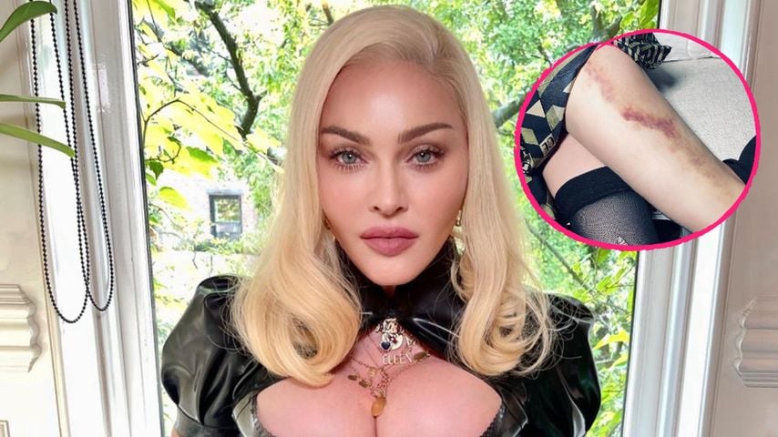 Die Fans sind in Sorge: Madonna zeigt XXL-Bluterguss am Bein