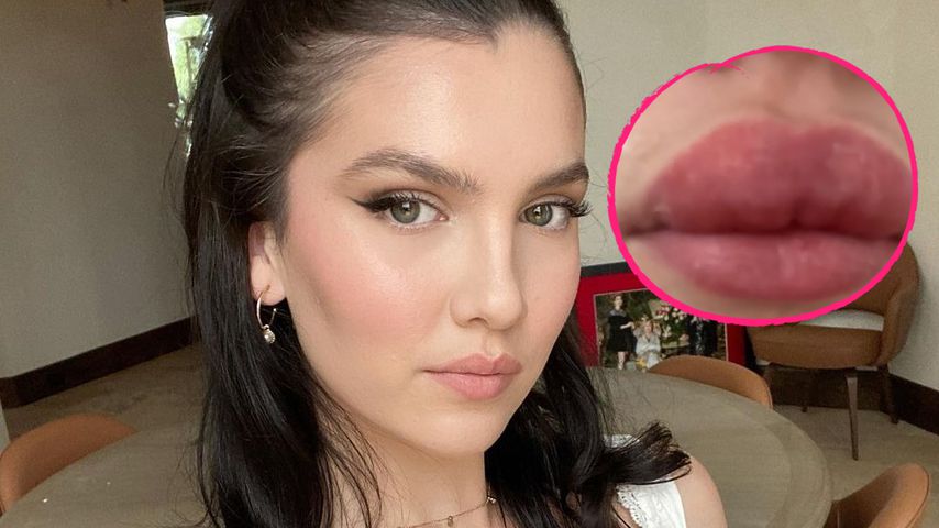 Lipfiller oder allergische Reaktion? Maya Henry klärt auf
