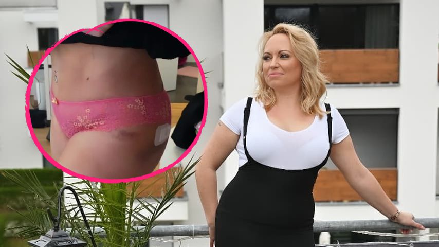 Fünf Tage nach Beauty-OP: "5 Senses"-Nicole zeigt Ergebnisse