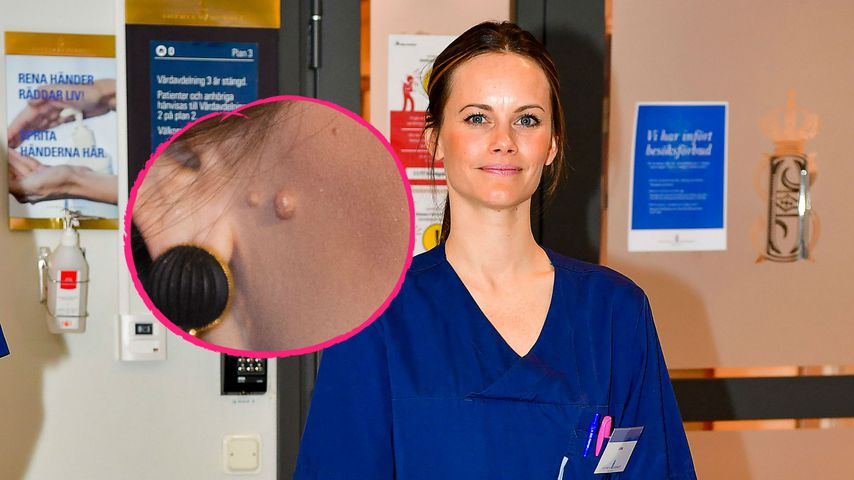 Beauty-Eingriff? Sofia von Schweden plötzlich ohne Muttermal