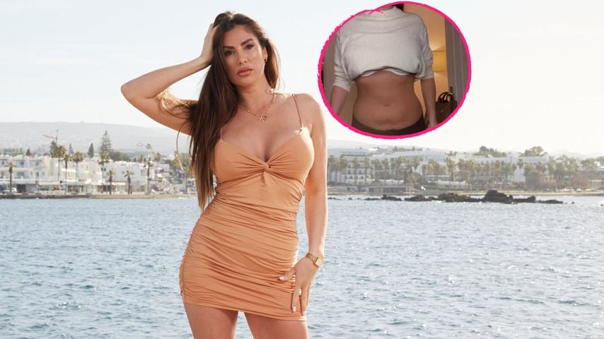 Ricarda Raatz zeigt Bauch zwei Wochen nach der Fettabsaugung