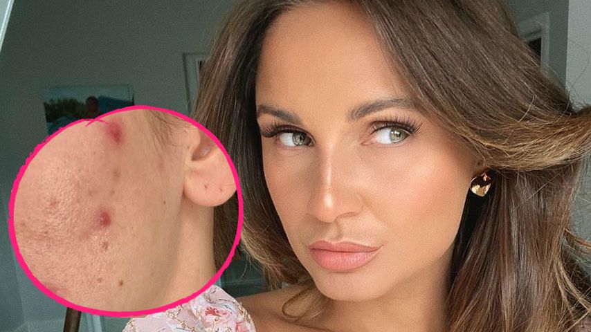 UK-Star Sam Faiers "oben ohne": Schlimme Akne durchs Stillen