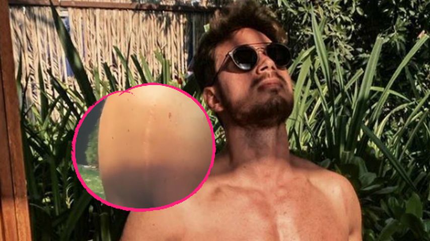 "Karriereende": Daher stammt Sebastian Panneks Schulternarbe