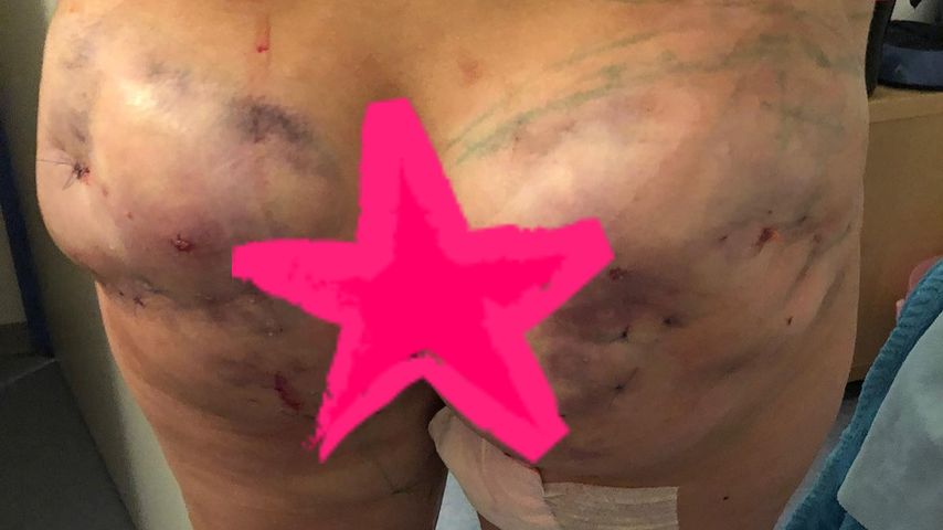 Natalia Osadas Hintern nach Brazilian Butt Lift
