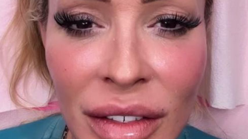 Nun natürlich: Cora Schumacher lässt ihre Lipfiller auflösen