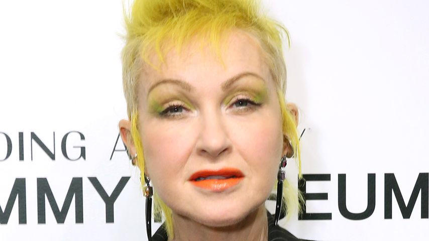 Cyndi Lauper kämpft seit Jahren mit schwerer Schuppenflechte