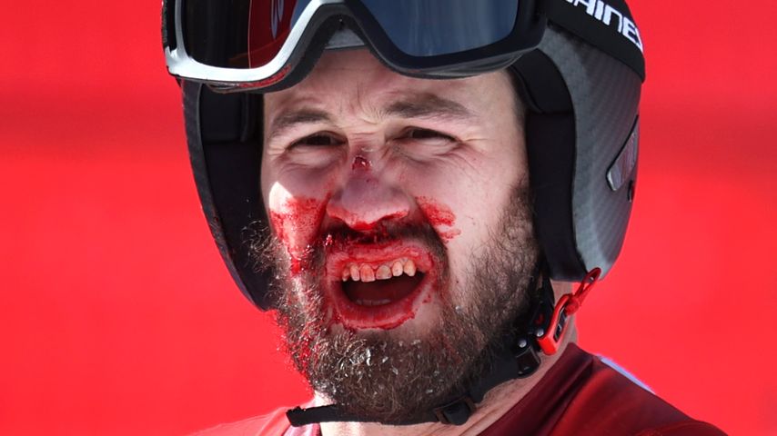 Mit Skistock: Olympionik schlägt sich selbst die Nase blutig