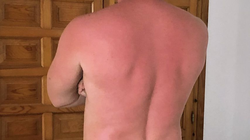 Autsch! Welcher Promi hat denn hier so üblen Sonnenbrand?