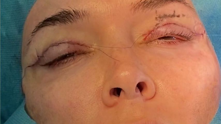 Daniela Katzenberger während ihrer Beauty-OP