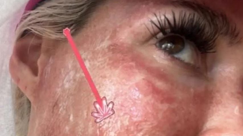 Beauty-Eingriff: Daniela Katzenberger lässt Gesicht lasern