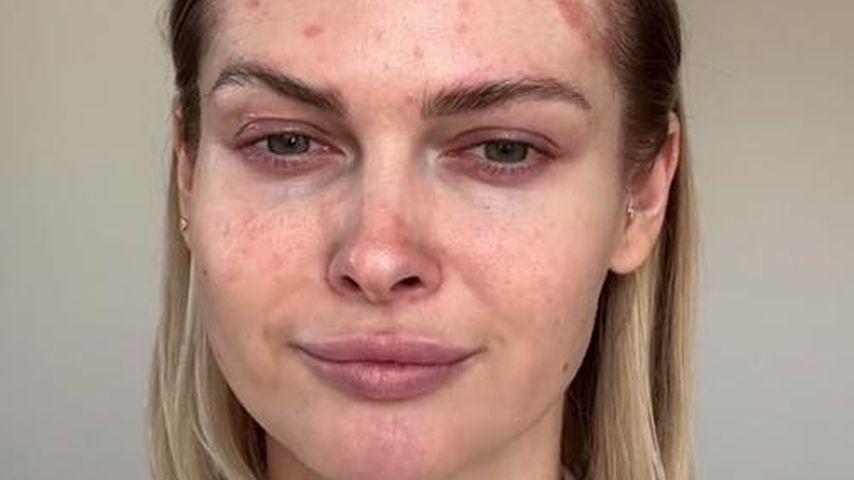 Darya Strelnikova will ihre Schuppenflechte nicht verstecken