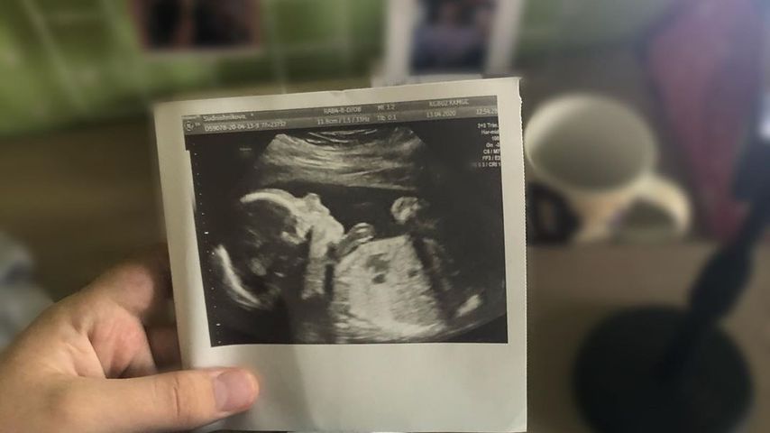 Ultraschallbild von Darya Sudnishnikovas Baby