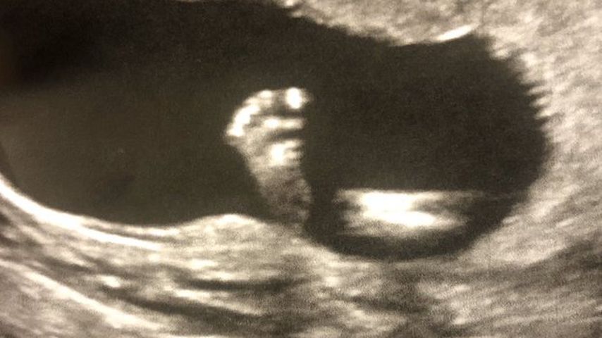 Ultraschallbild von Vanessa Morgans Baby