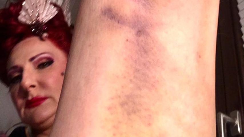 Désirée Nicks Bein nach ihrem "Promis unter Palmen"-Unfall