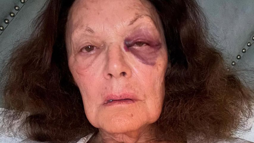 Aua: Diane von Furstenberg zeigt ihr blaues Auge nach Sturz
