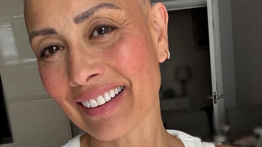Kreisrunder Haarausfall: Melanie Sykes zeigt sich mit Glatze