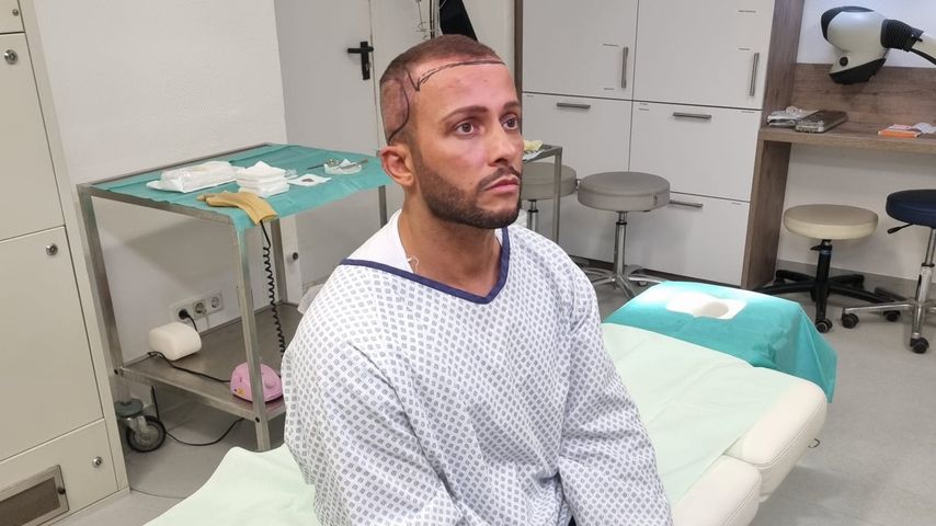So geht es Domenico De Cicco nach der Haartransplantation
