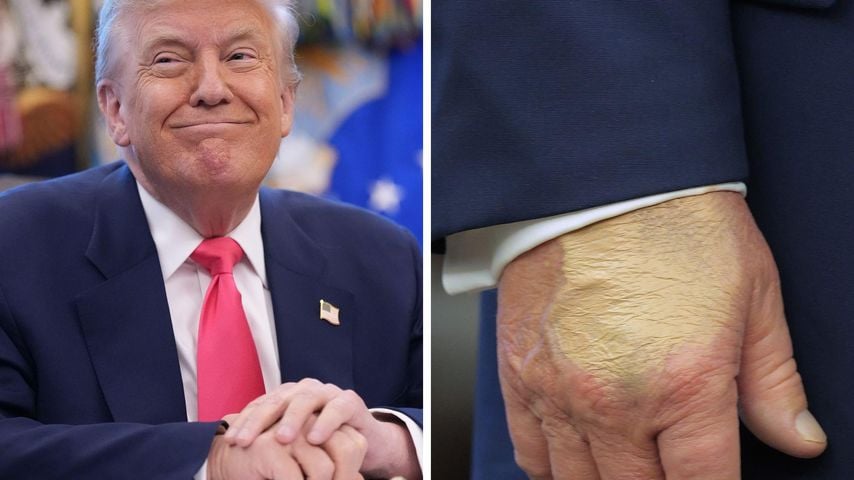 Donald Trumps Hand ist "vom vielen Händeschütteln" verfärbt