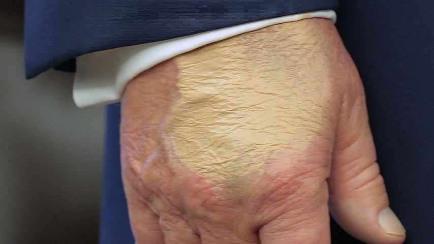 Donald Trump mit einer Verfärbung an der Hand, August 2025 in Washington
