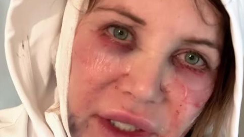 Grün und blau: Doreen Dietel nimmt Unterlidstraffung vor!
