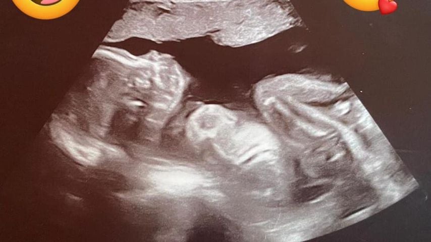 Ein Ultraschallbild vom Wollny-Nachwuchs