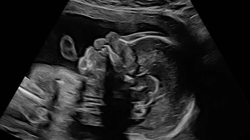 Ein Ultraschallfoto von Alex Hindermann und Laura Papendicks Baby