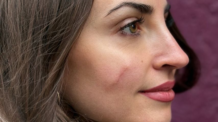 Ekat Leonova gibt ein Update zu ihrem entfernten Muttermal