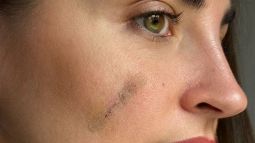 Tänzerin Ekaterina Leonovas Narbe