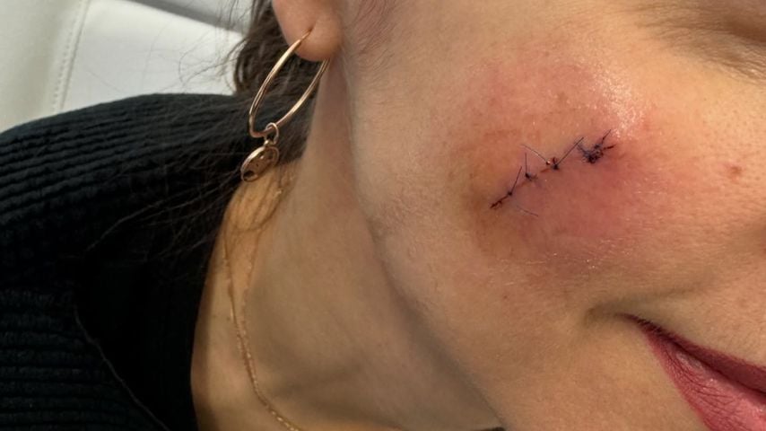 Wunde von Ekaterina Leonova