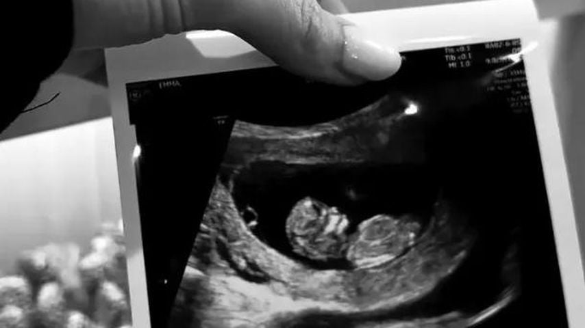 Ultraschallfoto von Emma McVeys Baby