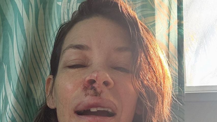 Evangeline Lilly zeigt ihre Gesichtsverletzungen