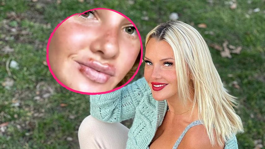 "Pechvogel": Evelyn Burdecki hat vier Lippen-Herpesbläschen