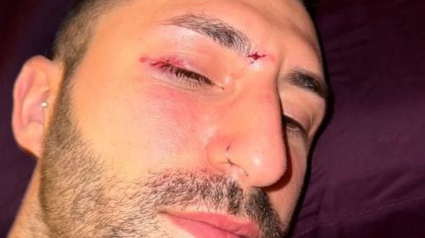 Wegen Albtraum: Fabio De Pasquale verlor fast sein Auge