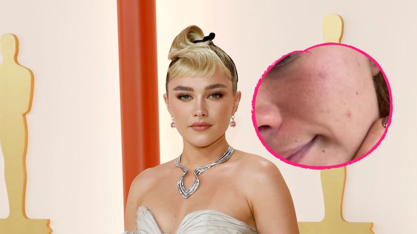 Florence Pugh witzelt über ihren Pickel vor den Oscars 2023