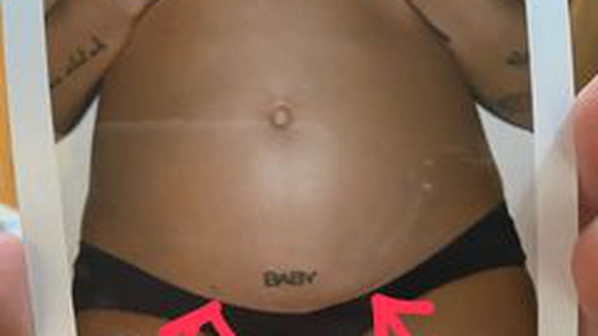 Foto von Halseys Endometriose-Narben