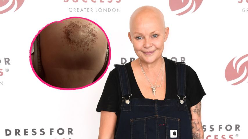 In Ohnmacht gefallen: Gail Porter erlitt einen Schädelbruch