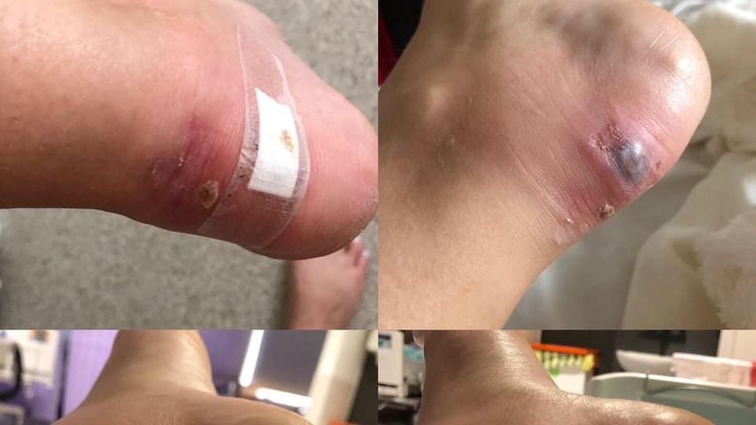 Gemma Downeys Fußverletzung